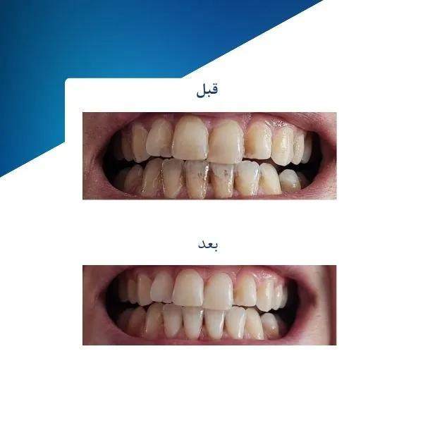 ژل سفید کننده دندان فاردنتو مدل TSR وزن 20 گرم مجموعه دو عددی — تصویر ۴